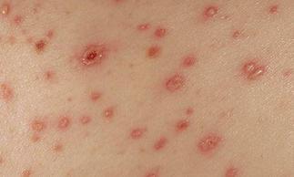 艾滋病的初期症状图片